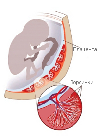 Преждевременное старение плаценты