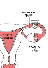 Внематочная беременность